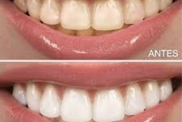 Comparativa visual de blanqueamiento dental