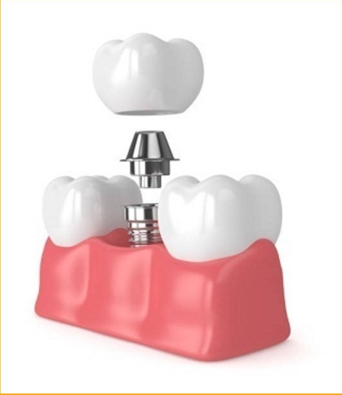 Representación de implante dental